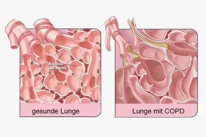 COPD Beispiel